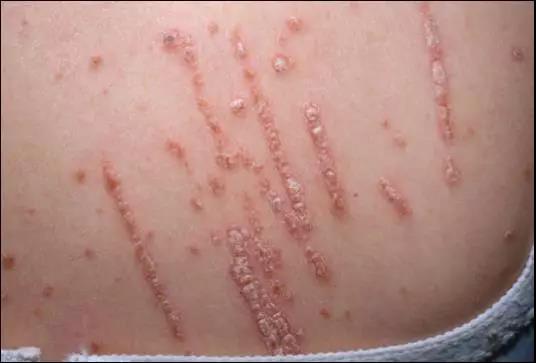 ţƤѢ�Ĳ���������ʲô_����רҵ����ţƤѢҽԺ