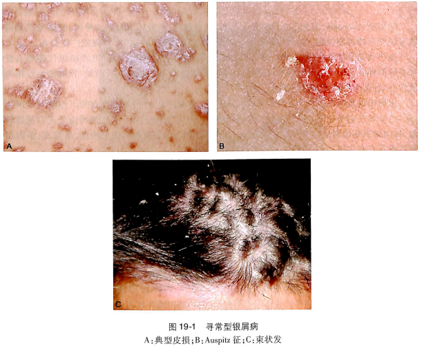 ��������ţƤѢר��_��������ţƤѢҽԺ_ţƤѢ���κ���