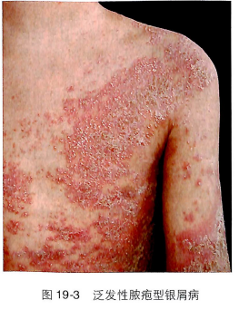 ��������ţƤѢר��_��������ţƤѢҽԺ_ţƤѢ���κ���