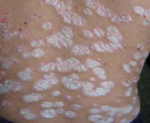 ţƤѢ�����ε�ԭ����ʲô_����ר����ţƤѢҽԺ