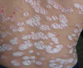 ţƤѢ�����ε�ԭ����ʲô_����ר����ţƤѢҽԺ