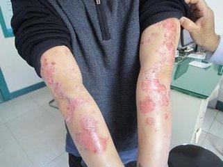 ţƤѢ�����ε�ԭ����ʲô_����ר����ţƤѢҽԺ