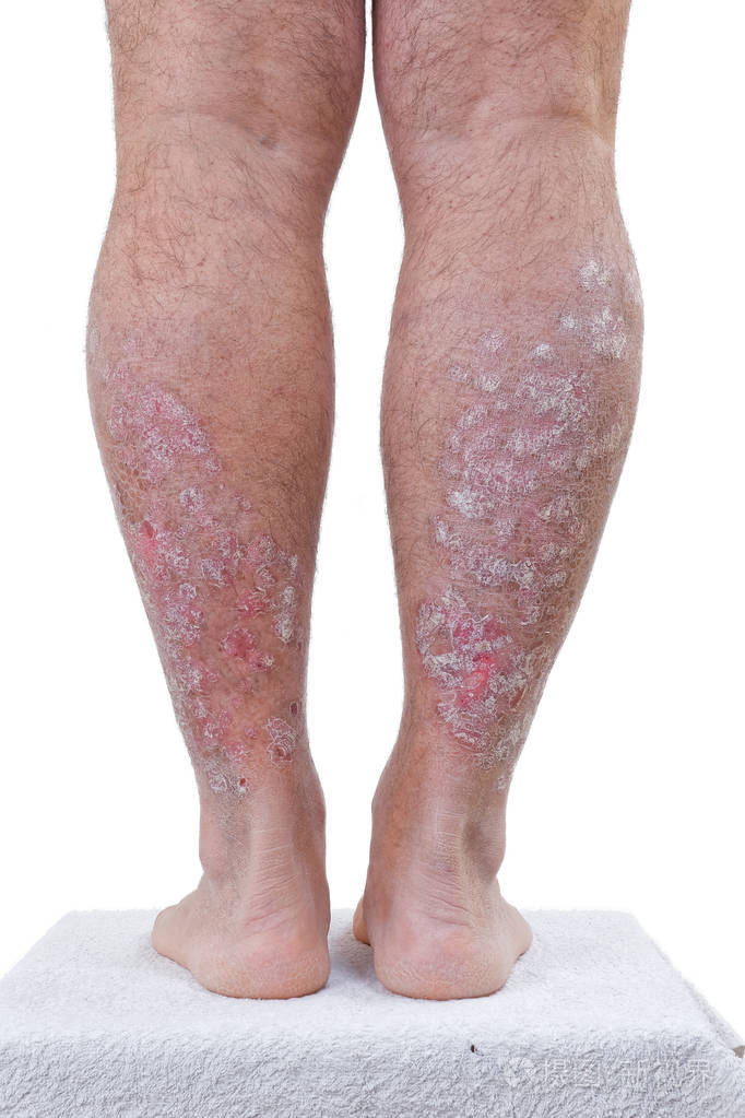 ţƤѢΪʲôһֱ�β���_����ר��ţƤѢҽԺ