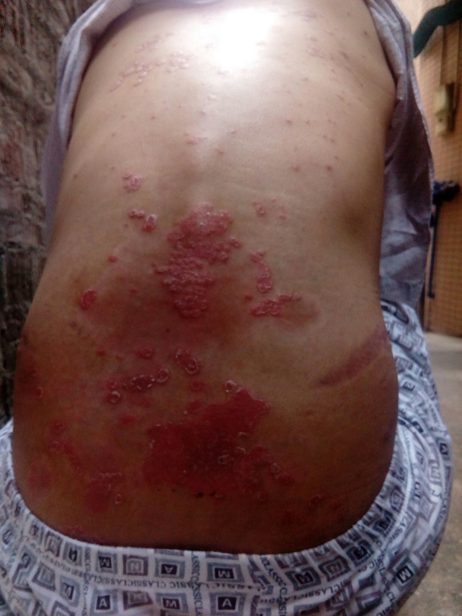 ţƤѢΪʲôһֱ�β���_����ר��ţƤѢҽԺ