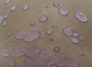 治疗牛皮癣要多少钱_海口治疗牛皮癣医院