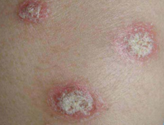 ����ţƤѢ�ķ�����ʲô_������ô����ţƤѢ_��������ţƤѢҽԺ