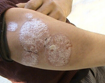 ����ţƤѢ���Ҫ������Ǯ_����ҽԺ����ţƤѢ�շѱ�׼_