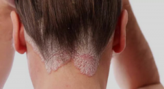 ţƤѢ����Ҫע��ʲô,����ţƤѢ����ô��-���ڷ�������ţƤѢҽ