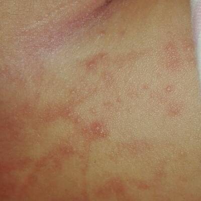 ��������Ƥ��ҽԺ����Щ������Ƥ�׸߷�����ôԤ��